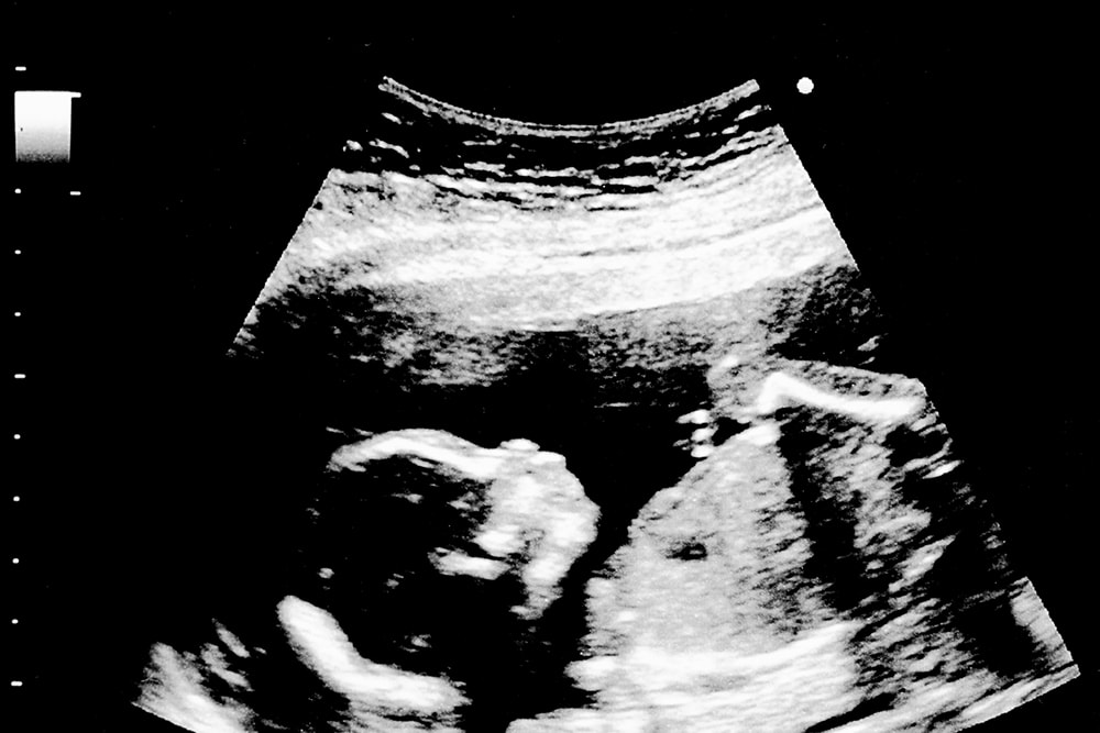 Ce se întâmplă cu bebe în săptămâna 18 de sarcină